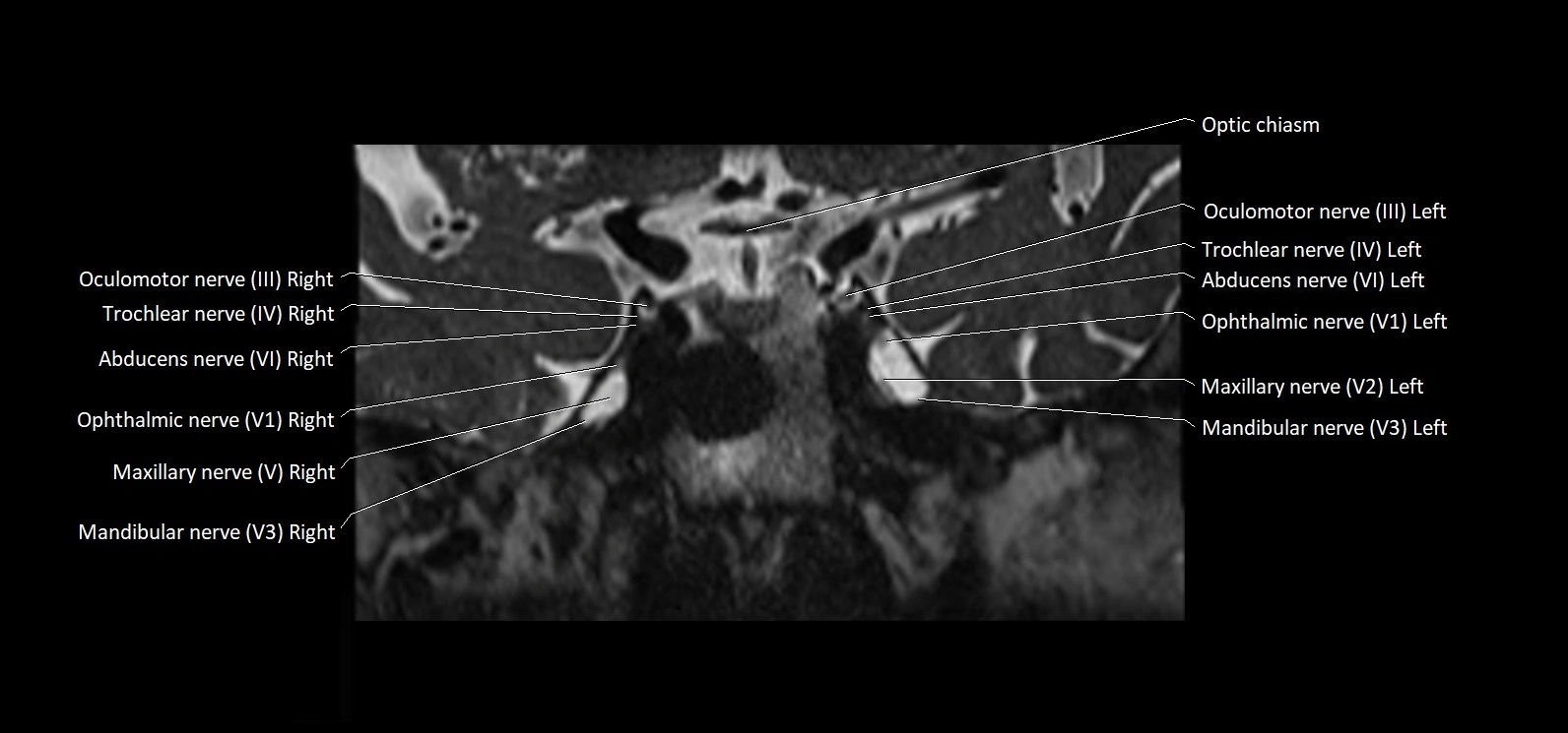 Cranial nerve cross sectional anatomy coronal 3T MRI image 29.webp